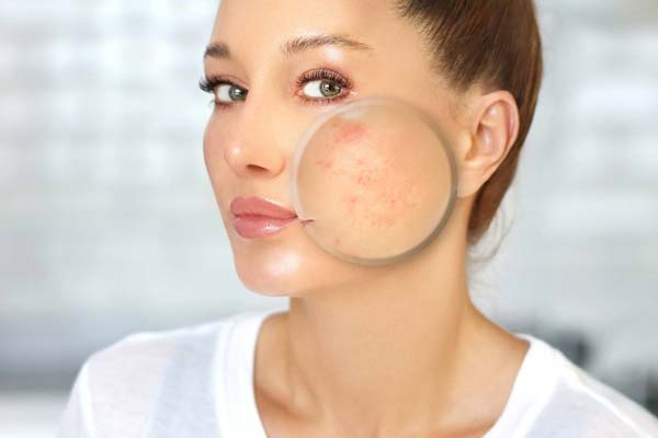acne scar treatment in Haldwani