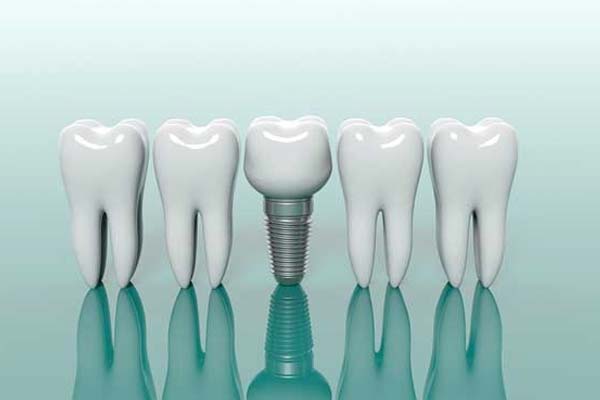 dental implant in Haldwani